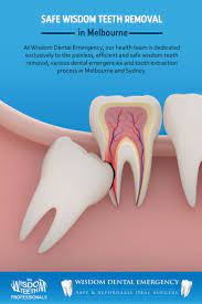 Pin On Wisdom Dental Emergency