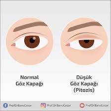 Gozleri Cok Kasimak Ovalamak Veya Sertce Silmek Zamanla Goz Kapagi Dusuklugune Yol Acabilir Goz Kapaklarimiza Nazik Davranmaliyiz Gozkapa Bilgi Sise Tintin