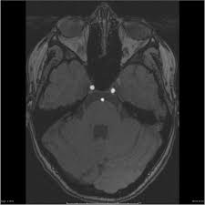 Carotid Cave Aneurysm Coiled And Mca Fenestration Carotid Cave Aneursyms Have A Complex Relationship To The Du Aneurysm Subarachnoid Hemorrhage Fenestration