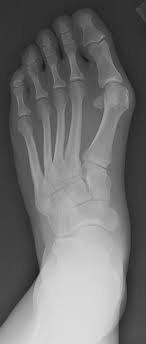 Hallux Valgus - Bunions | UW Orthopaedics and Sports Medicine, Seattle