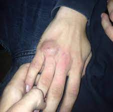 Dadurch schwillt der finger an und ist nur noch eingeschränkt beweglich. Kapselriss Med Kom