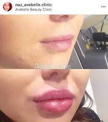 Lip Filler Before And After Botox Lips Lip Fillers Cheek Fillers