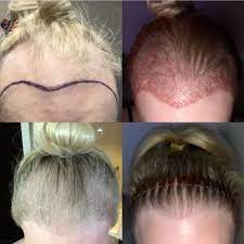Christopher Varona On Instagram Progression From Before Hair Transplant To 7 Months We Did 40 Hair Transplant Hair Transplantation Hair Transplant Procedure