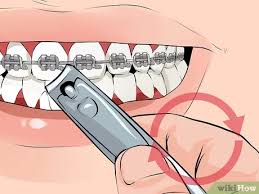 When taking your braces off, your orthodontist will have to use some pressure to take off the brackets and get all the glue off your teeth, but it won't hurt. How To Fix A Broken Braces Wire 6 Steps With Pictures Wikihow