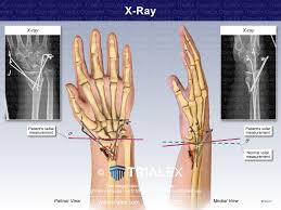 Image result for Wrist XRay