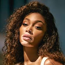 Image result for Vitiligo