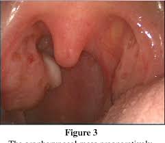 Image result for tonsilla palatina