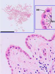 Benign fibrous mesothelioma of the pleura: Benign Papillary Mesothelioma Download Scientific Diagram