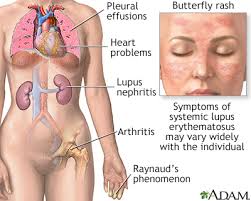 Systemic Lupus Erythematosus