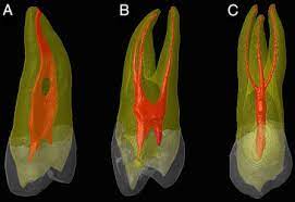 Read the article below to find out whether you might need a root canal. Root Canal Treatment Upm Malaysia Oh Root Canal Treatment Upm Malaysia Klse Malaysia