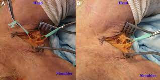 Measurement Of Outlet Pressures Favors Rib Resection For Decompression Of Thoracic Outlet Syndrome The Annals Of Thoracic Surgery