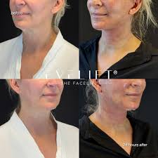 I feel like I'm 40 again!” 💙 Meet Lyn*, 67-years-young from Sarasota.  These photos were taken just 6 days after her EVELift® — and the  transformation speaks for itself. “You definitely are