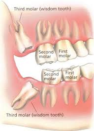 If you are older than age 30, you have only a small risk of having problems with your wisdom teeth. Is It Safe To Have All Four Wisdom Teeth Removed At Once News Dentagama