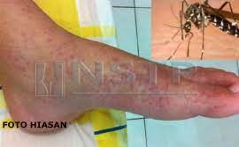 Jangan bersenam semasa anda demam. Rawat Segera Demam Denggi