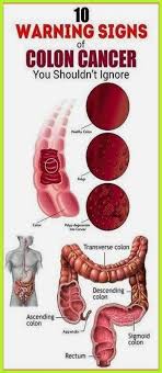 A feeling that your bowel doesn't empty completely. Ex 24 Colon Cancer Warning Signs Cancer