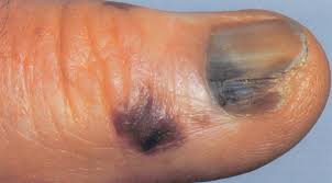 Image result for Acral lentiginous melanoma nail