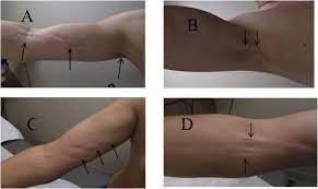 Review Of Axillary Web Syndrome What The Radiologist Should Know European Journal Of Radiology