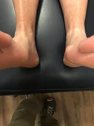 Image result for Functional Leg Length Discrepancy