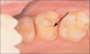 Image result for Tooth Fracture