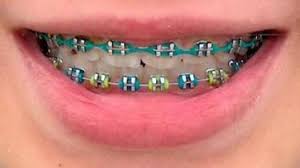 Jika karet behel di depan mulut rusak, anda dapat mencoba memasangnya lagi ke balik lengkungan kawat atau di sekeliling bracket.; 8 Tips Memilih Warna Karet Behel Yg Bagus Cantik Indah