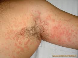 Image result for Trombicula autumnalis bites