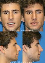 Rhinoplasty Before And After Patient Photos Nose Job Rhinoplasty Male Nose Job