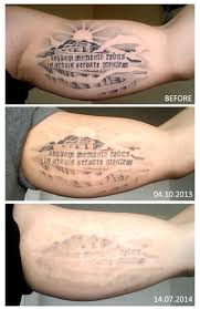 Check spelling or type a new query. Complete Inner Bicep Tattoo Removal Review Realself