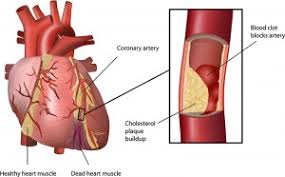 L'infarctus du myocarde traitement naturel