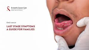 Image result for gum cancer symptoms