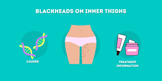 Here's how to remove blackheads without causing damage to your skin. Blackheads On Inner Thighs Causes And Treatments Skincare Hero