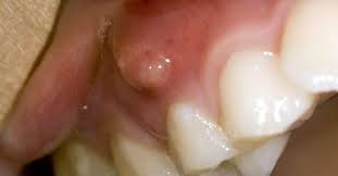 The size of the boil may go down, but it will always come back, until the infection is locally treated. Gum Boils What They Are And How To Treat Them