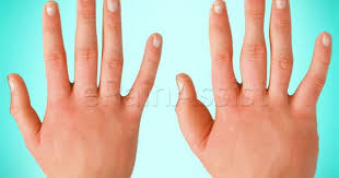 Pin On Rsd Crps Chronic Regional Sympathetic Complex Dystrophy