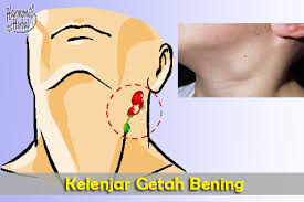 Kanker kelenjar getah bening atau limfoma merupakan kanker yang berkembang di jaringan kelenjar getah bening atau kelenjar limfa. Gejala Kanker Getah Bening Yang Kerap Sasar Usia Muda