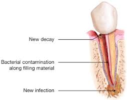 Warum kann ich mit einer wurzelbehandlung kosten sparen? Endodontische Revision Praxis Clauder Partner