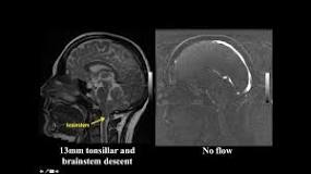 Image result for cine mri brain to see csf flow through cerebral aqueduct