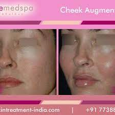 He's seen and done almost everything in his more than 30 years of experience, and he's ready to share his insights with you. How Can I Achieve Cheek Lift Mid Face Volume At The Apples Of Cheeks Without The Cheekbones Sticking Out From The Side Photo