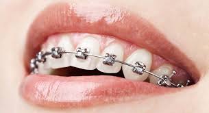 Using an orthodontist in a more rural area will often result in a lower cost, while orthodontists in big cities are more likely to charge more. Understanding Metal Braces For Orthodontic Treatment