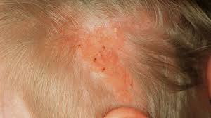 A nevus sebaceous is a rare type of birthmark that can be found on the face, neck, forehead, or scalp. Nevus Sebaceus Altmeyers Encyclopedia Department Dermatology