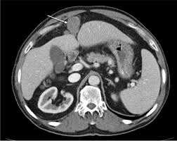 03.08.2021 · to identify correlation between ct imaging features and histologic subtypes of malignant peritoneal mesothelioma (mpm). Malignant Peritoneal Mesothelioma Correlation Between Ct Imaging Features And Histologic Subtypes Springerlink