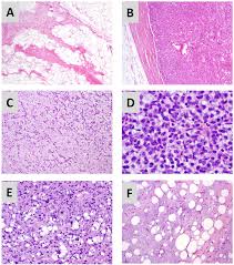 Image result for Liposarcoma