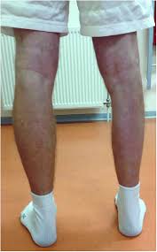 Pain is most common, in particular, those affecting the preganglionic fibres. Arm Muscle Atrophy Shefalitayal