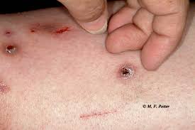 Image result for mite bites on humans