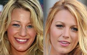 Burnini plastik operatsiya qildirgan mashhurlar