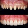 Ceramic/Metal Free Crowns/Tooth Caps by Dentist in Dwarka product image