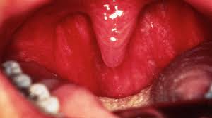 Image result for Physical injury red spots roof of mouth