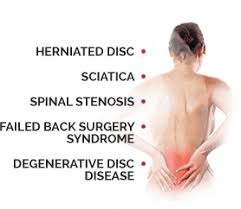 The Bonati Spine Institute Above Beyond Laser Spine Surgery Spine Surgery Surgery Degenerative Disc Disease