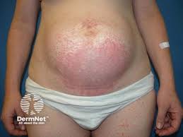 Image result for pruritic urticarial papules and plaques of pregnancy