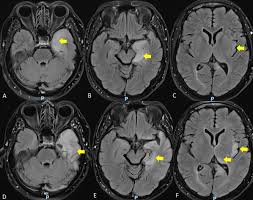 Image result for HSV Encephalitis