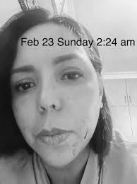 Alma Concepcion, nakagat sa mukha ng kanyang aso