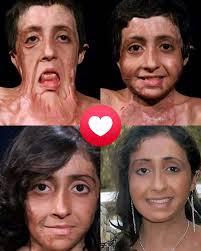 Anant Kothari, Director at Anan Jewels, turned his childhood scars into a  source of strength and purpose. Through his accidental burn, he found a way  to empower others by establishing the Anan